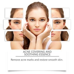 Acne Soothing Hydrating Facial Care Serum Solution